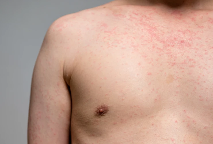 sarampion chihuahua.jpg