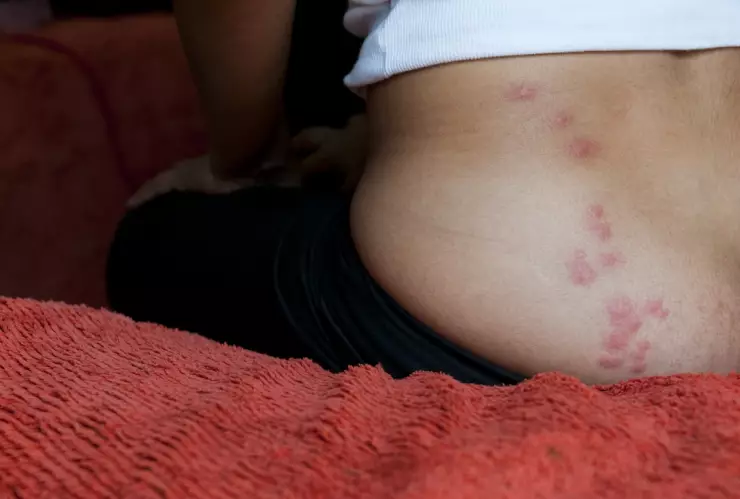 Picadura de chiche: Cómo identificar el piquete fácil y rápido