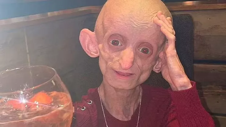 Ashanti Smith, una joven que padecía de la enfermedad de Benjamin Button, falleció en Reino Unido.