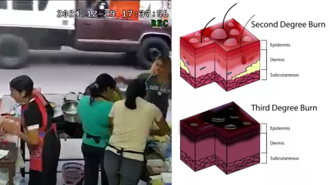 Quemaduras con aceite hirviendo Xalapa Veracruz mujer es agredida por comensales.