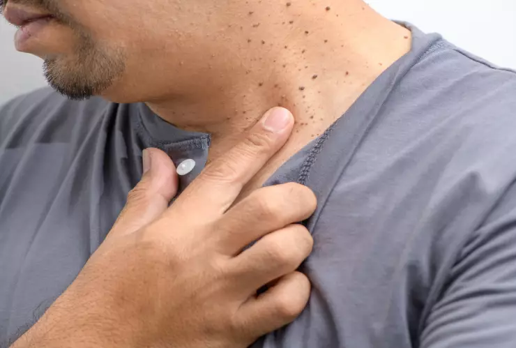 ¿Qué significa cuando me salen verrugas en el cuello?