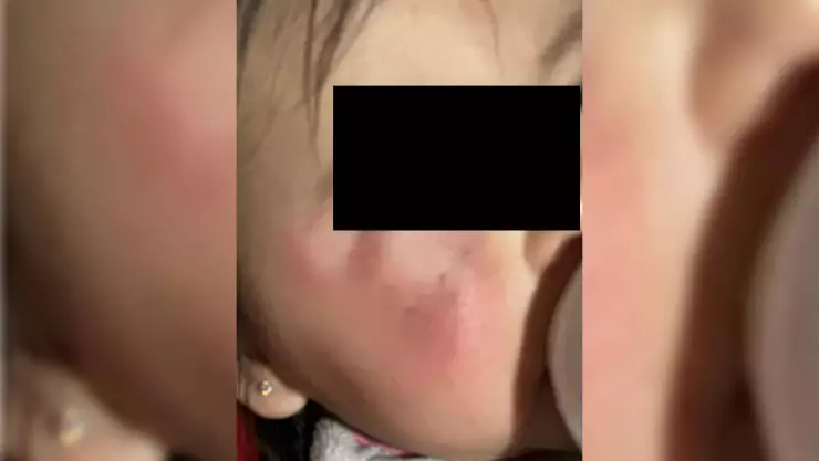 Guardería entrega a bebé fuertemente golpeada, en Mérida (FOTOS)