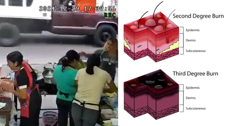 Quemaduras con aceite hirviendo Xalapa Veracruz mujer es agredida por comensales.