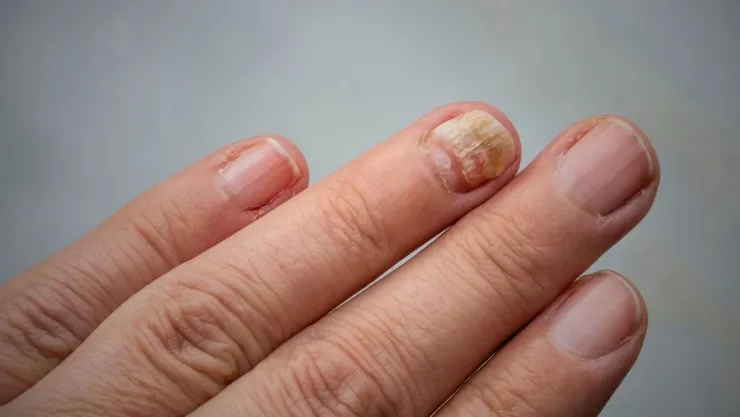 Uñas amarillas por hongos cómo ocultarlas de forma estética mientras las tratas.jpg