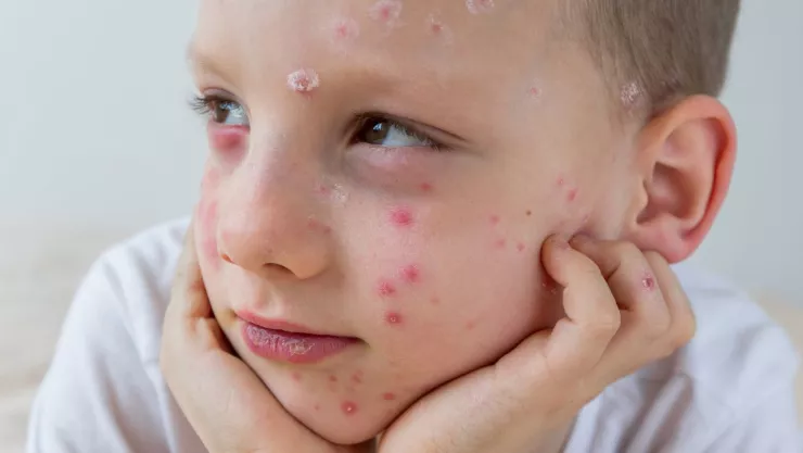 Salpullido en niños