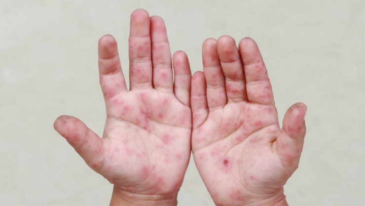 virus Coxsackie