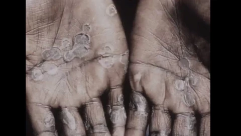 Viruela del Mono .jpeg