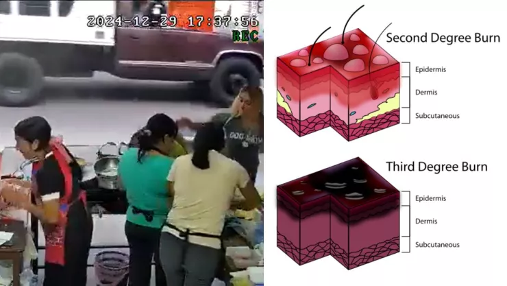 Quemaduras con aceite hirviendo Xalapa Veracruz mujer es agredida por comensales.