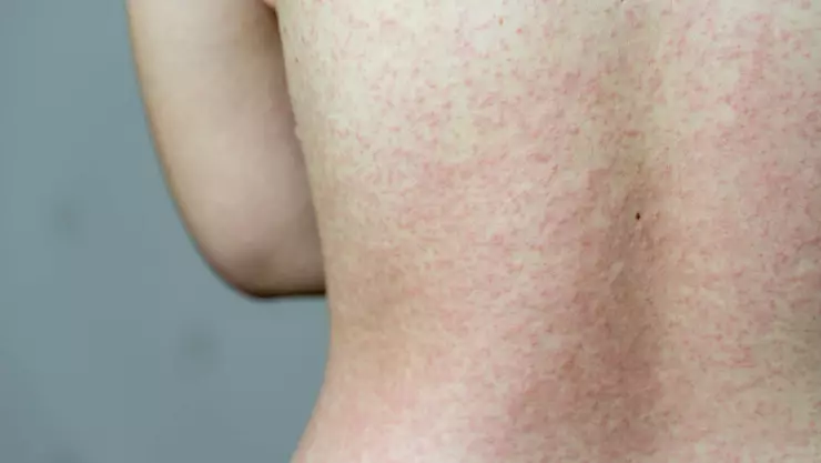 casos de sarampión en Chihuahua