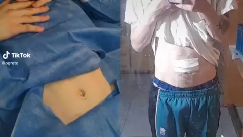 Joven se quita el ombligo porque solo acumula suciedad