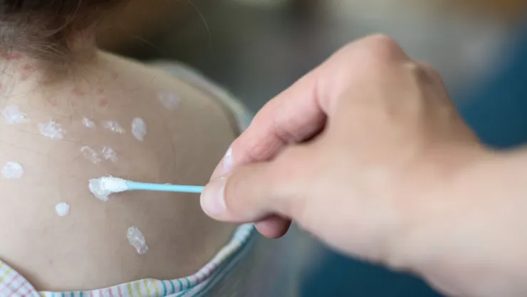 ¿Cómo identificar la viruela del mono y el herpes zóster? Estos son los síntomas