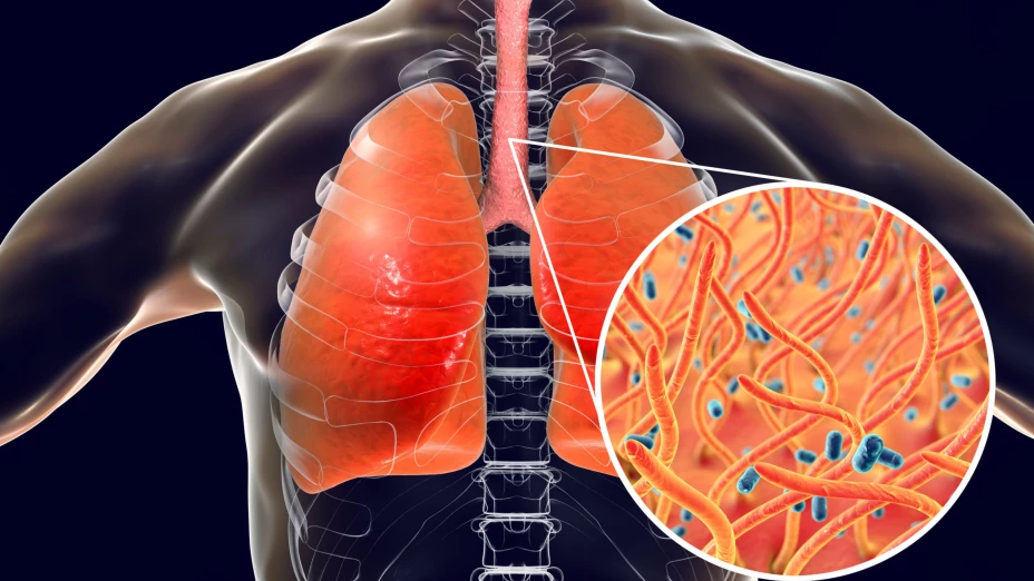 Suman 13 casos confirmados de tos feina en Morelos.