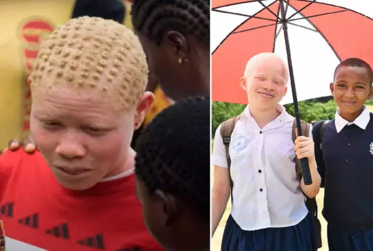 En algunos países, las personas con albinismo mueren por cáncer de piel entre los 30 y 40 años.