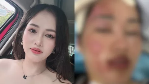 VIDEO | ¡Imágenes sensibles! Mujer sufre graves quemaduras en el rostro al explotarle un globo de cumpleaños