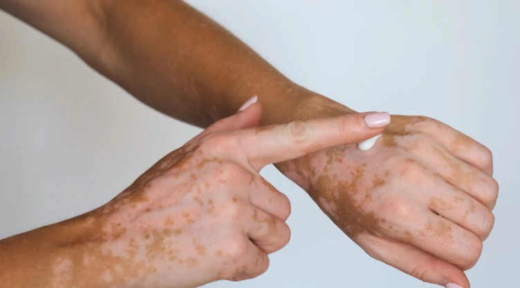 vitiligo-enfermedad-piel-manchas-causas.jpeg