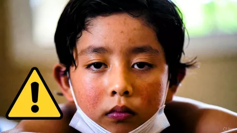 Expertos alertan sobre la “amnesia inmunológica”, secuela que compromete las defensas del cuerpo