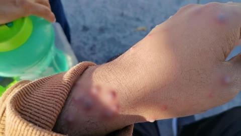 Yucatán registra CUARTO CASO de viruela símica en 2025; ¿Qué tan PELIGROSA es?