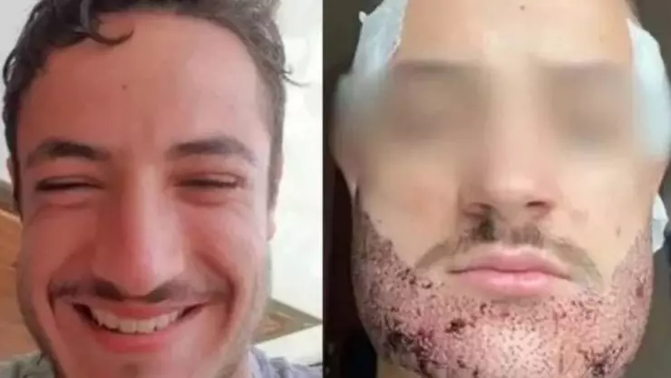 trasplante de barba fallido