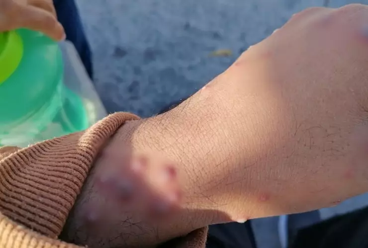 Yucatán registra CUARTO CASO de viruela símica en 2025; ¿Qué tan PELIGROSA es?