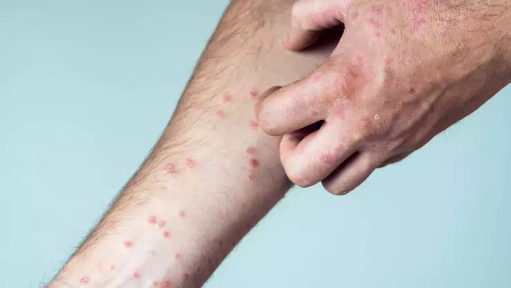 Dan de alta a último paciente de Sarampión