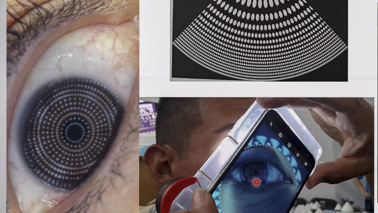 detectar problemas de ojo seco y/o de queratocono