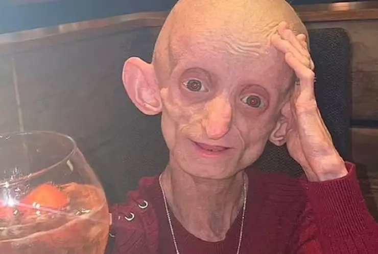 Ashanti Smith, una joven que padecía de la enfermedad de Benjamin Button, falleció en Reino Unido.