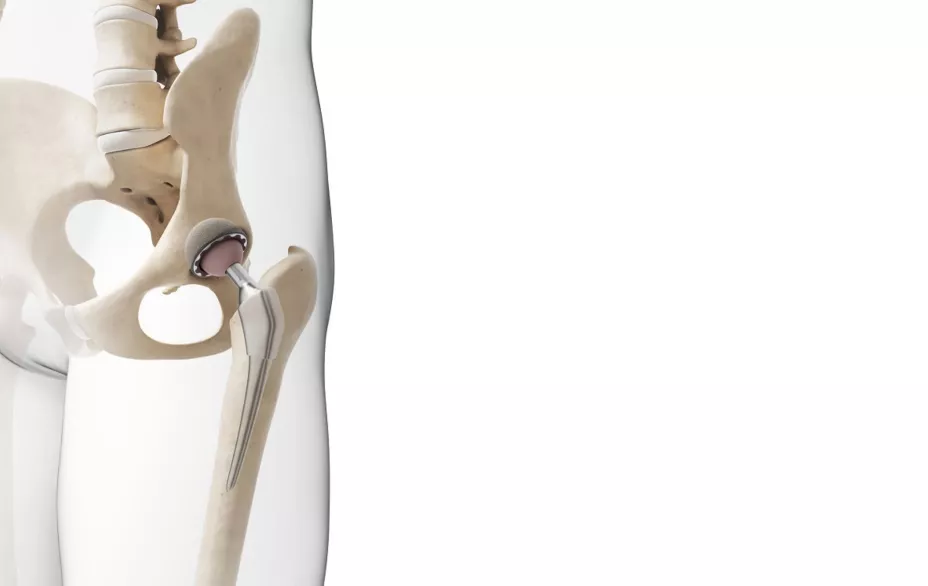 Reemplazo de cadera Flow.jpg