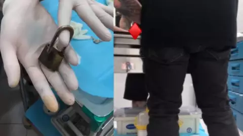 VIDEO: Se pone un candado en el pene y pierde la llave por 8 meses