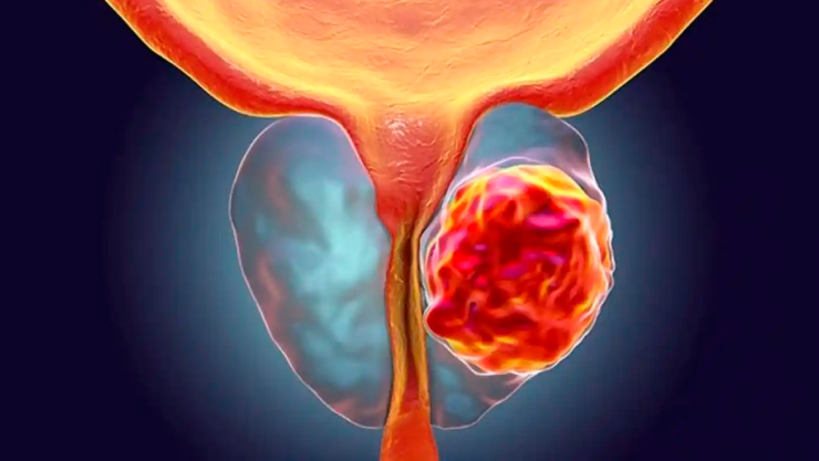 Cáncer de próstata