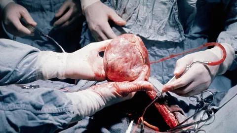 Heart Transplant Operation