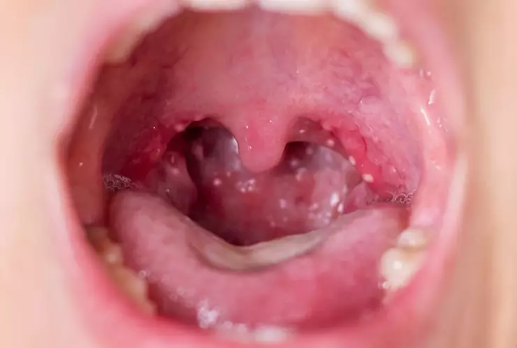 Casos de escarlatina en México y cuáles son los síntomas