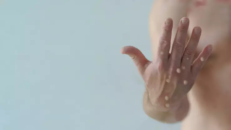 Estos son los animales que transmiten la viruela del mono