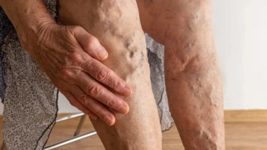 Le REVIENTA una várice y MUERE en su casa; así ocurrió la TRAGEDIA