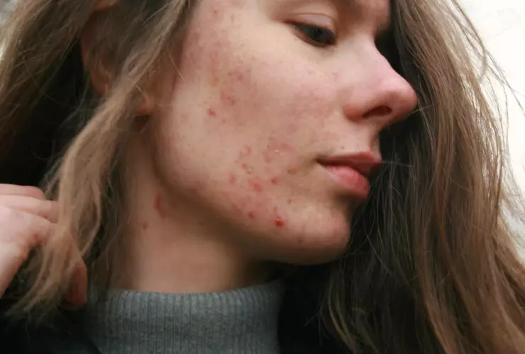 3 formas de utilizar la vaselina para eliminar las manchas del rostro