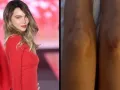 belinda heridas caida.jpg