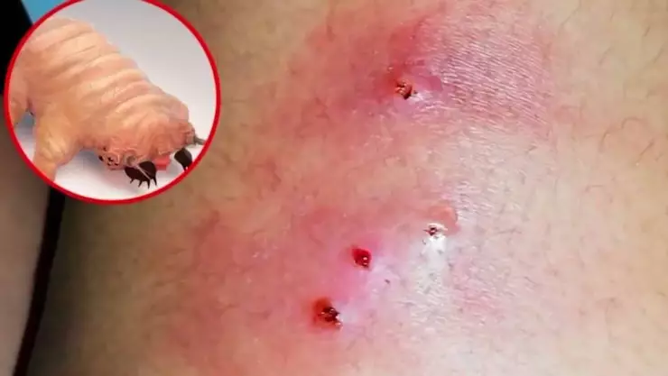 miasis en humanos.jpg