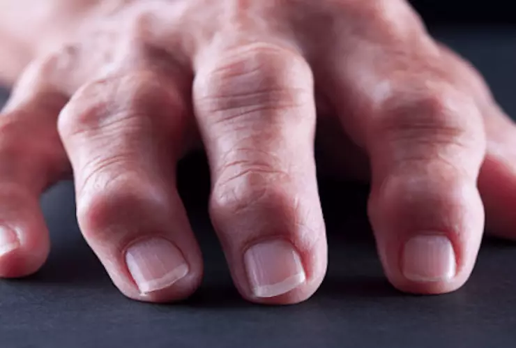 Fármaco para la artritis reduce la mortalidad por COVID-19 en un ensayo