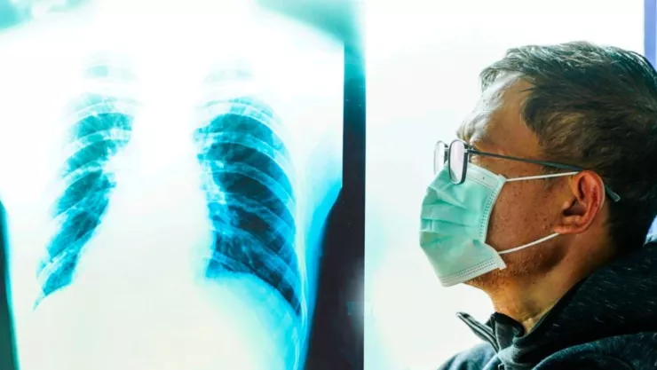 Metapneumovirus humano, HMPV: Síntomas del virus ¿Cómo detectarlos en México este 2025?