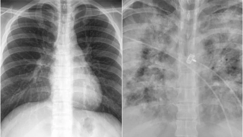 pulmones covid-19 personas no vacunadas.jpg