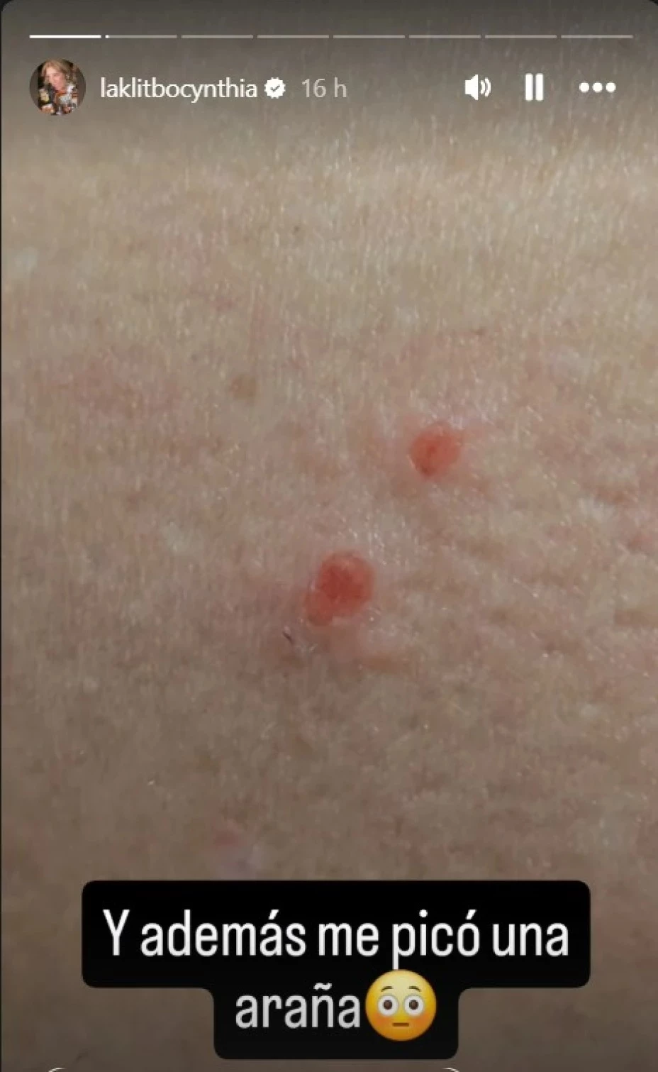 cynthia klitbo picada araña