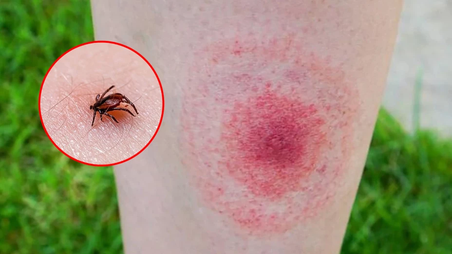 mordedura garrapata.jpg