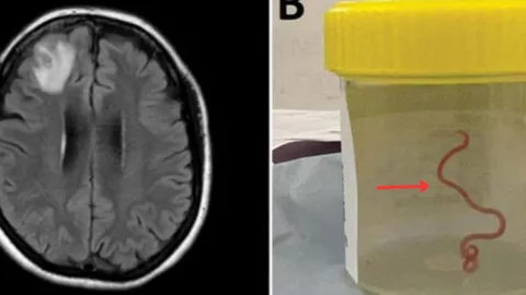 Médicos extraen gusano vivo en el cerebro de una mujer en Canberra