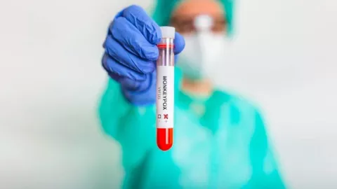 México con 35 casos de viruela de mono hoy 14 de julio 2022.