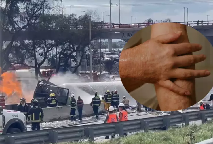 Aprende los cuidados para una quemadura por gas de primer, segundo y tercer grado. Información confiable y fácil de entender.