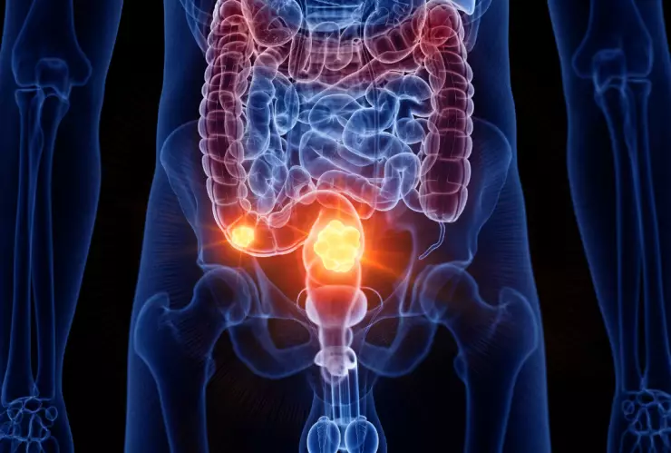 Cáncer de colón