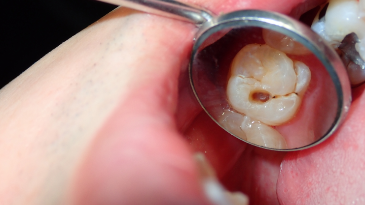 Señales de que un menor podría tener caries dental.