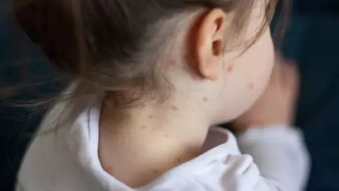 OMS emite alerta mundial por casos de sarampión.