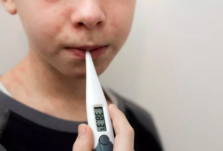 México registra más de 500 casos de sarampión.