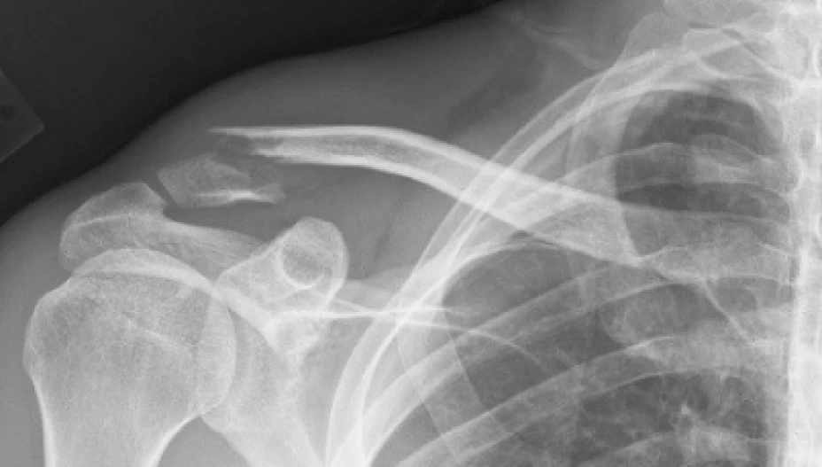 osteoporosis