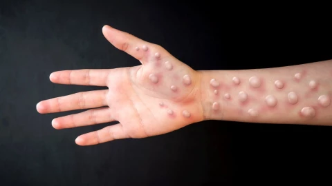 Qué significa que la cepa de viruela del mono tenga “potencial pandémico”